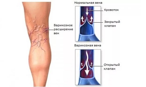 Варикоз - это генетическое заболевание, которое характеризуется слабой стенкой у сосудов и недостаточностью клапана аппарата