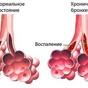 хронический бронхит фото