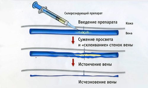 Одним из способов лечения варикоза является склеропластика. Процедура может быть чем-то схожа с лазерной коагуляцией и тоже представляет собой активное лечение варикоза без операции на поздних его стадиях