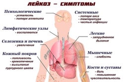 Основные симптомы лейкоза