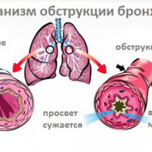 Механизм обструкции бронхов