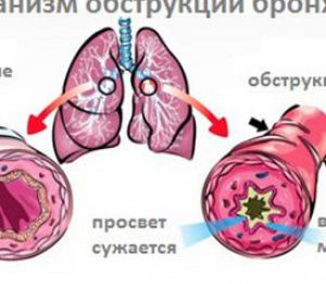 Что такое обструктивный бронхит и как его лечить?